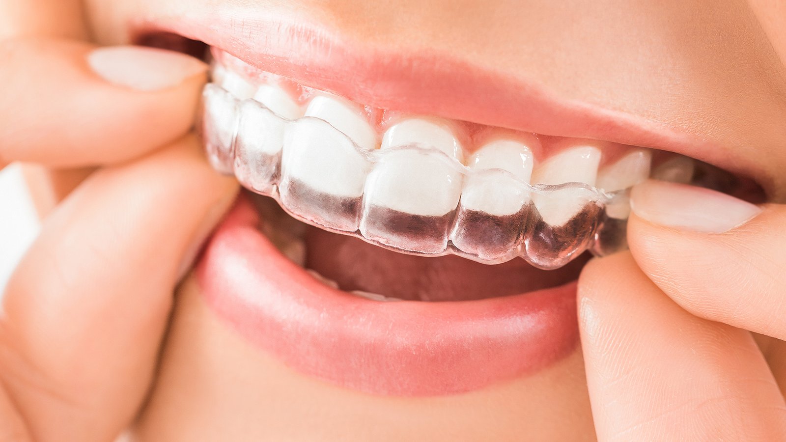 DiamonDent - Satélite -Diseño de Sonrisa