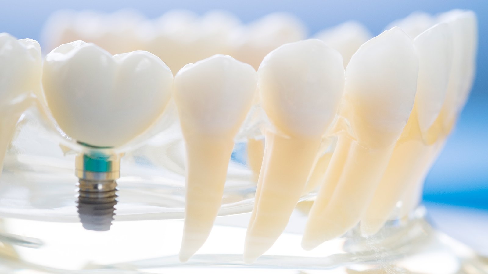 DiamonDent - Satélite -Diseño de Sonrisa